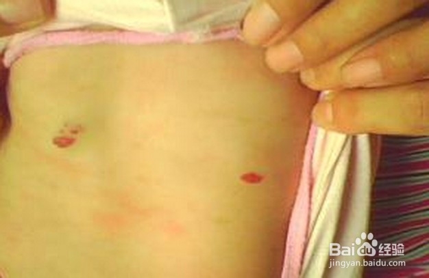 脂肪肝及常见的肝病预防