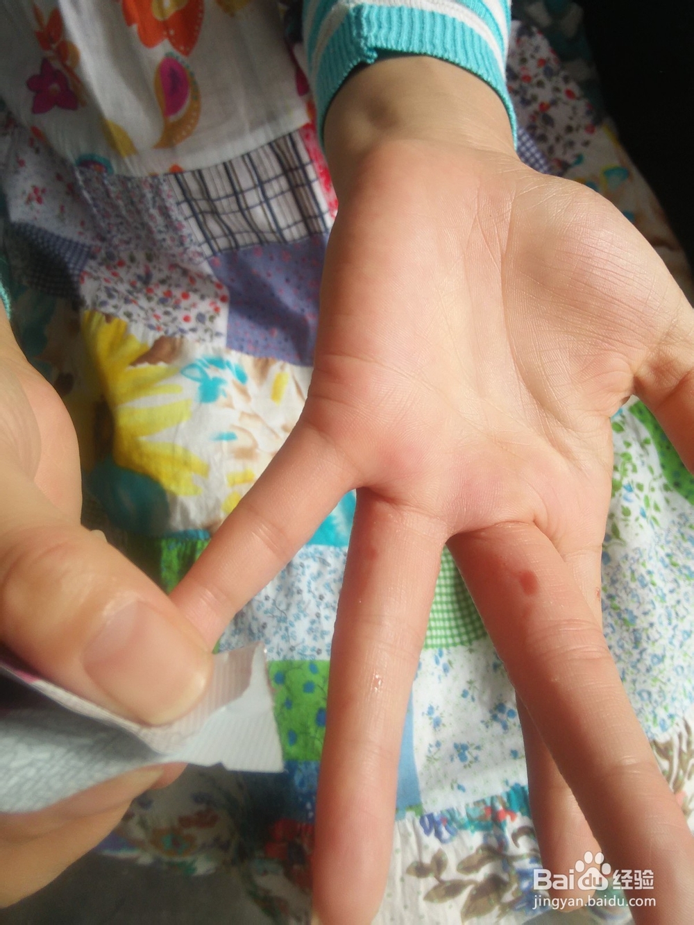 分享手上长水泡如何治愈的方法