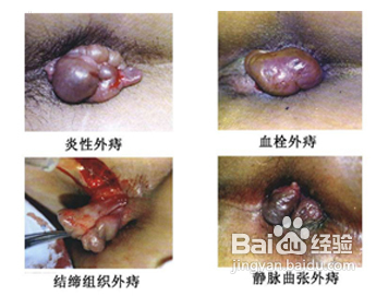 痔疮的分类及治疗有哪些