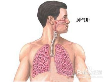 肺气肿传染人如何预防