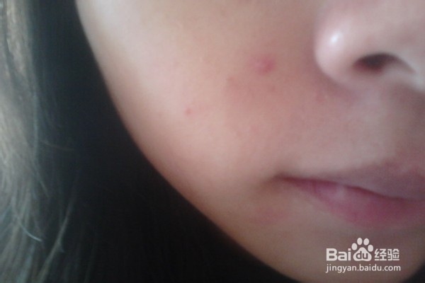 如何用PS去除脸上的痘痘