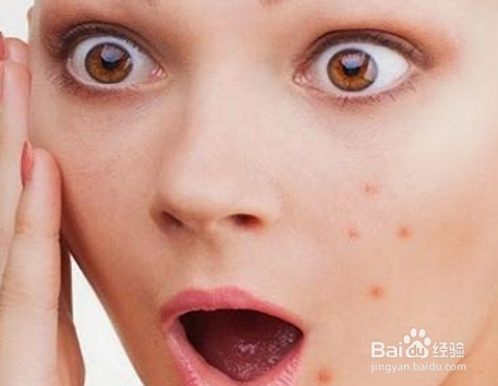 皮肤科医生揭示痤疮的主要原因