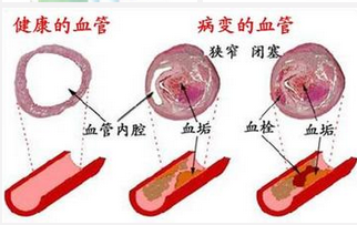 从身边做起：重视脑卒中
