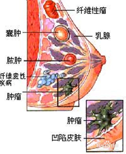 乳腺增生会引起哪些地方痛