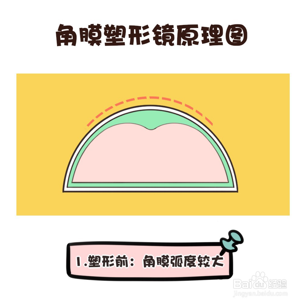 角膜塑形镜的原理