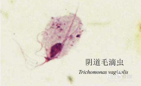 滴虫性阴炎【新】