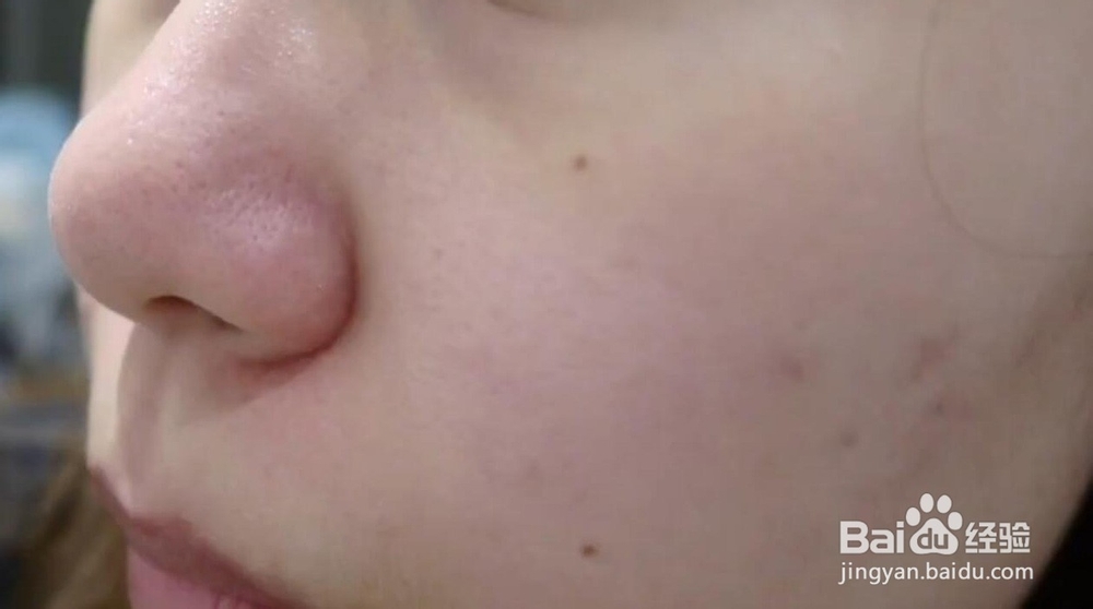 黑头粉刺如何自然根除