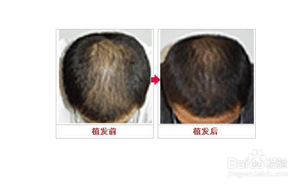 毛发移植技术是怎样的？