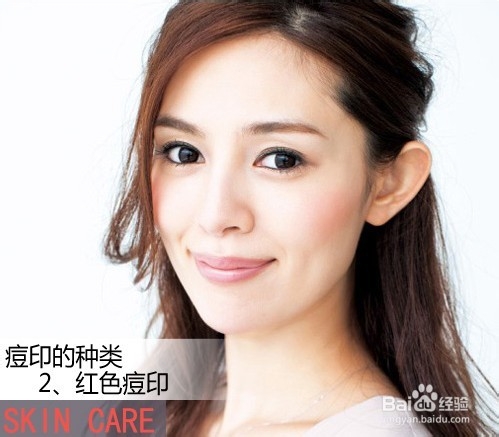 【消退痘印】 7个方法结合攻陷