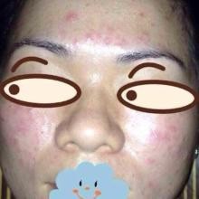 怎么样简单的消灭讨厌的各种痘痘，一星期见效。