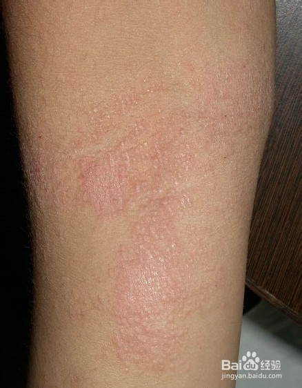 为宝宝驱蚊虫怎样洒花露水安全