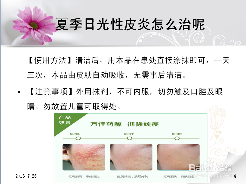 日光性皮炎能 根 治 吗