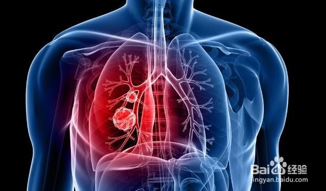 影响男性的最常见类型的癌症