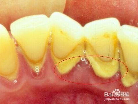 怎么知道有牙石