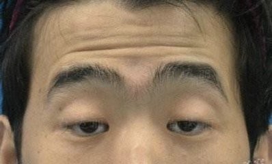 重症肌无力早期症状包括哪些？