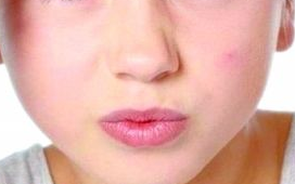 痘痘不小心破了怎么办