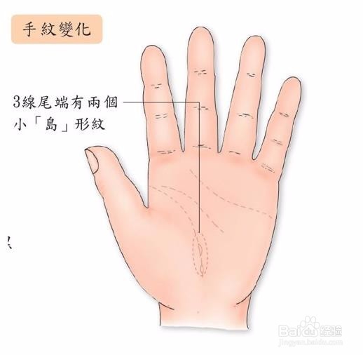 子宫肌瘤怎么办？子宫肌瘤手操疗法缓解病状