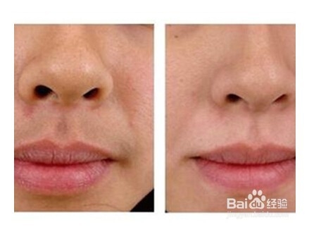 唇毛怎么去除?唇毛可以永久去除吗?