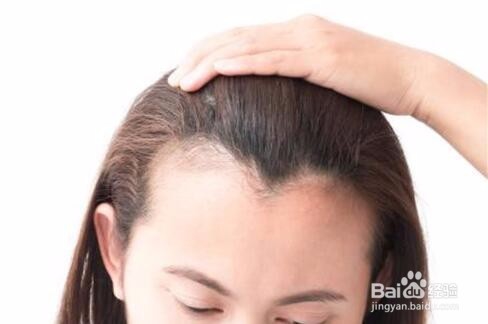 发际线后退严重怎么办?送恢复经验