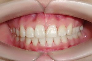 龅牙的价格是多少?