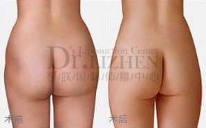 自体脂肪丰臀价格