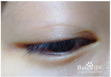 内双变成开眼角双眼皮的技巧