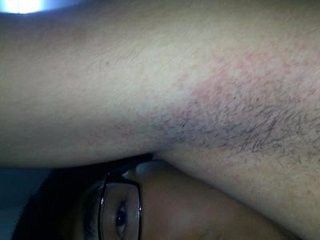 腋下湿疹症状有哪些_治疗方法 【用药大全】