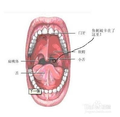 被鱼刺卡住怎么办