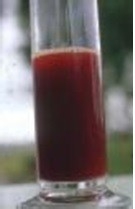 如何认识“肾结石”