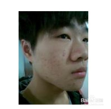 最好的男士祛痘产品怎样祛痘