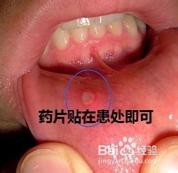 出现口腔溃疡怎么办?