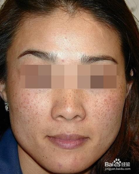 脸上长黄褐斑怎么治能彻底治愈