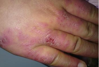 手上生冻疮怎么治疗