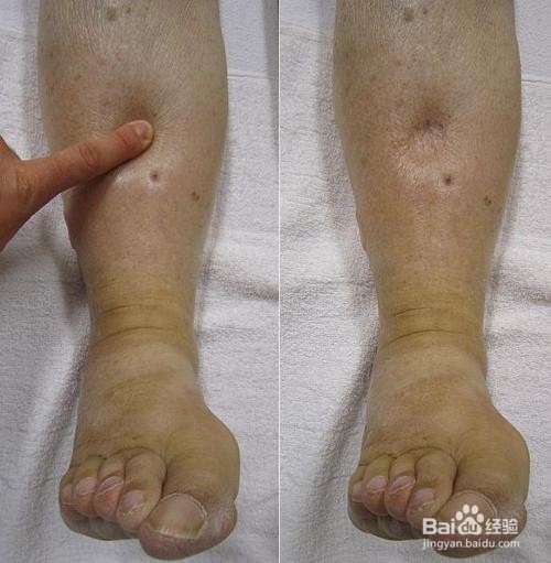 怎么区分自己是肥胖还是有腹水？