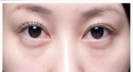 导致眼袋的原因以及预防方法