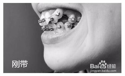 牙齿矫正 虎牙 一年侧面对比图 百度经验