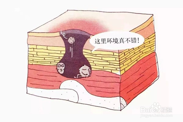 空腔型褥疮怎么治疗