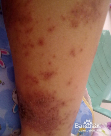 孕妇手脚长湿疹怎么办