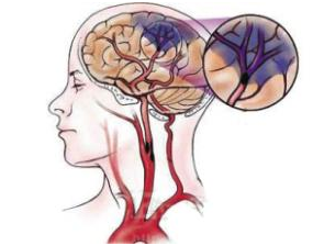 脑梗塞能治好吗 脑梗塞最佳治疗方法!