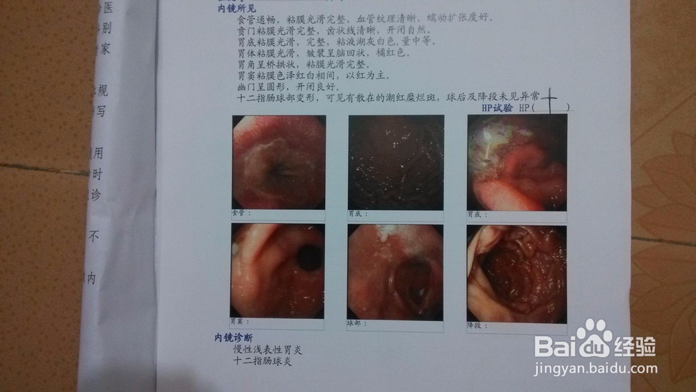 体检浅表性胃炎怎么办？