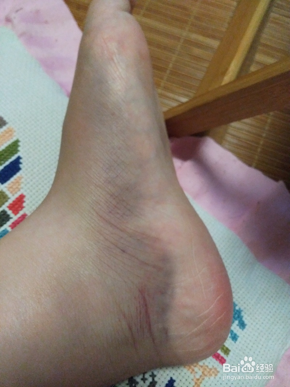 常见的运动损伤和处理方法