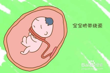 胎宝宝脐带绕颈危险大吗孕妈妈应该做些什么