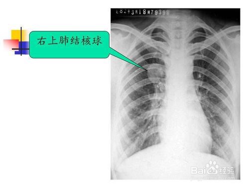 X射线是怎么成像的