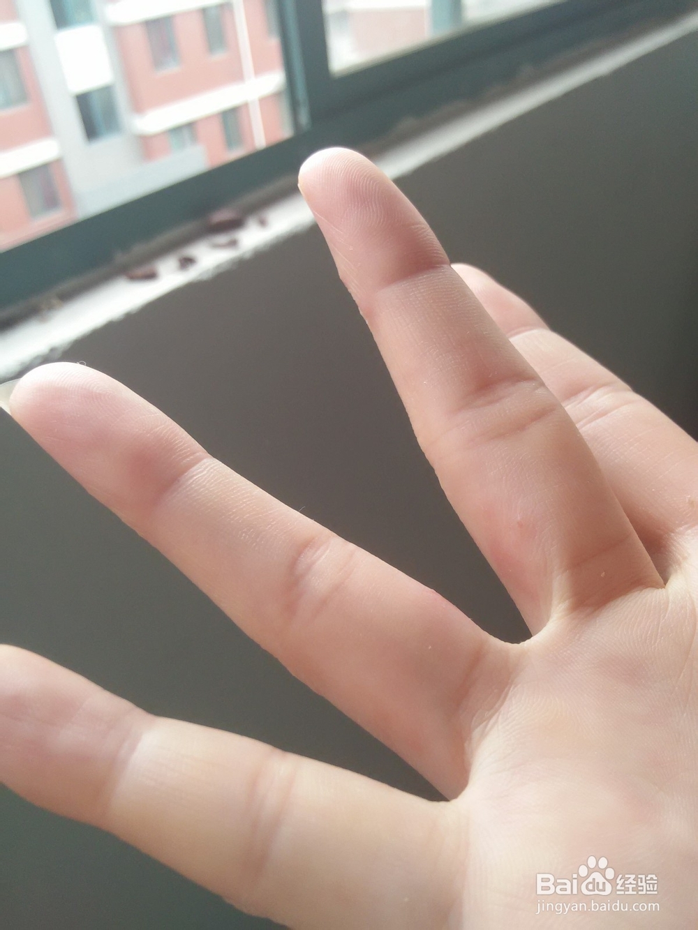 分享手上长水泡如何治愈的方法