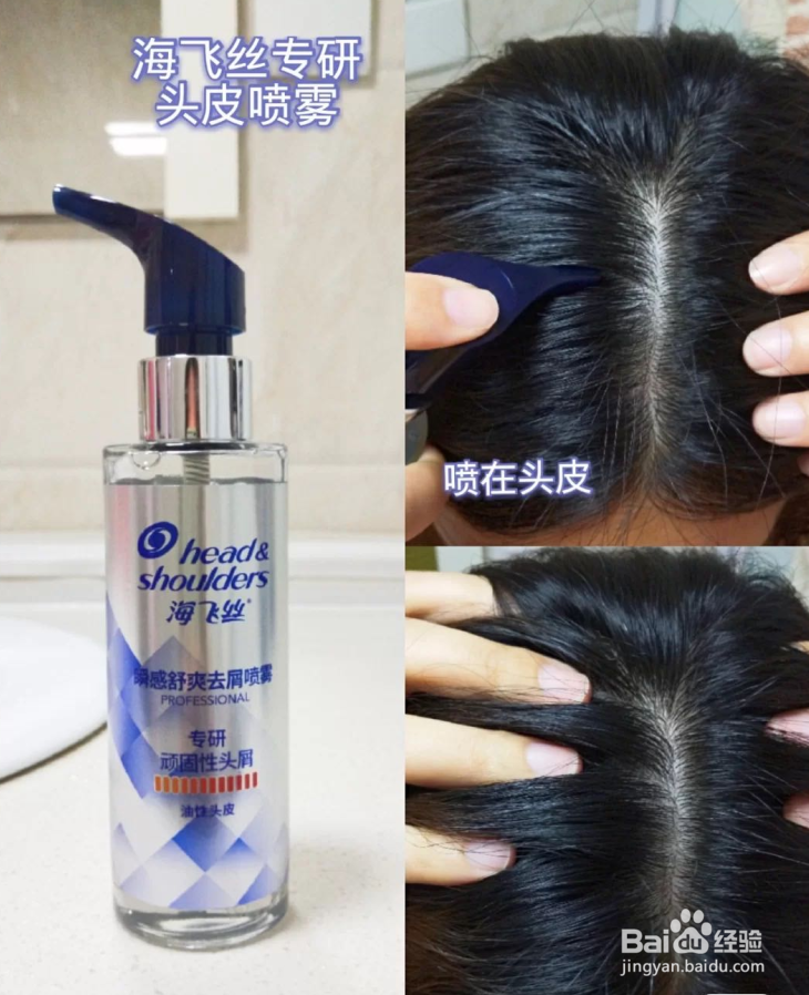 去屑小妙招有哪些?3个去屑小妙招试试看