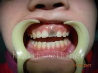 睡觉时牙疼怎么办