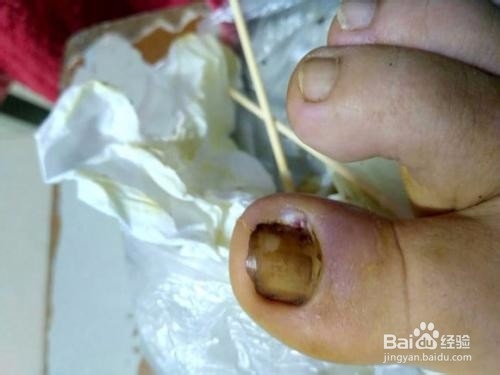 令人头疼的甲沟炎如何预防