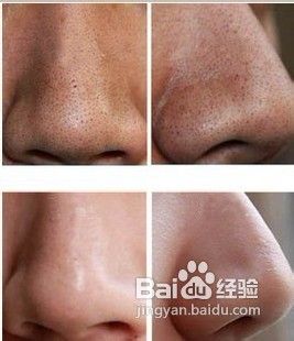 黑糊糊的鼻头怎么样去掉