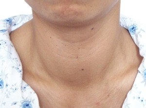 怎么早期发现甲状腺结节