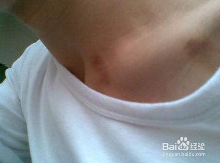 脖子吻痕怎么消除